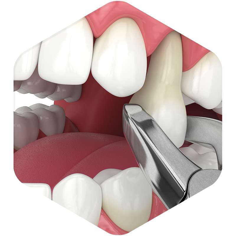3D illustration of a tooth extraction.